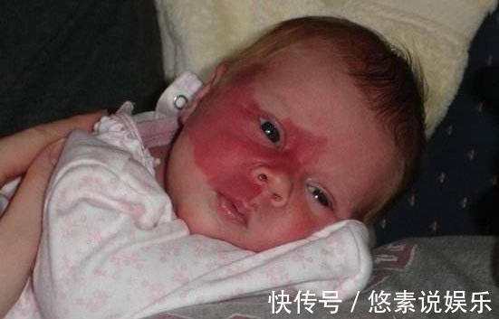 胎儿|怀孕期间不会吃水果造成胎儿出生满脸胎记,孕期吃水果要注意3点