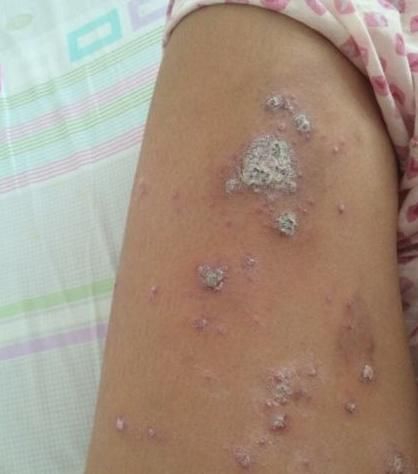 芡实|湿疹反反复复？“1敷、1喝”根治它，简单方便