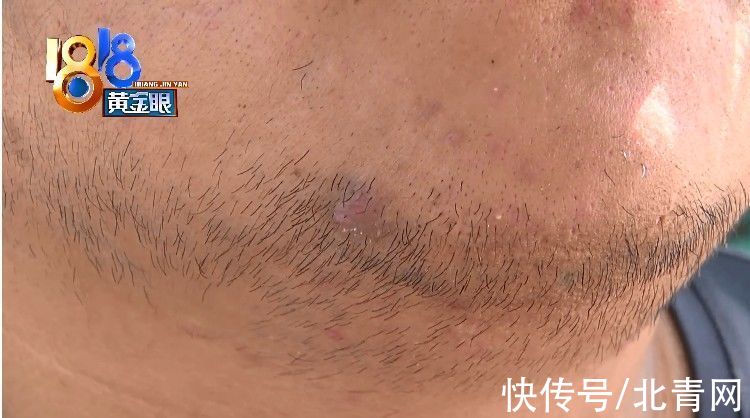 管理机构|小伙脸上长脓包“痘院士”强调“没来”
