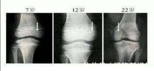 婴儿肥|孩子出现3个信号,是''骨线闭合''的前兆,宝妈早发现还能补救