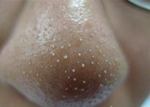 鼻子周围挤出白色米粒？为何医生不让挤？今天就给大家科普一下！
