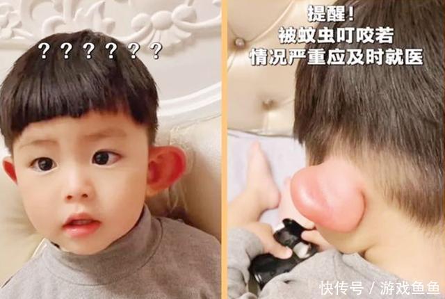 花露水|宝宝被蚊子咬成“大耳朵图图”，又疼又痒还留疤，怎么处理最好？