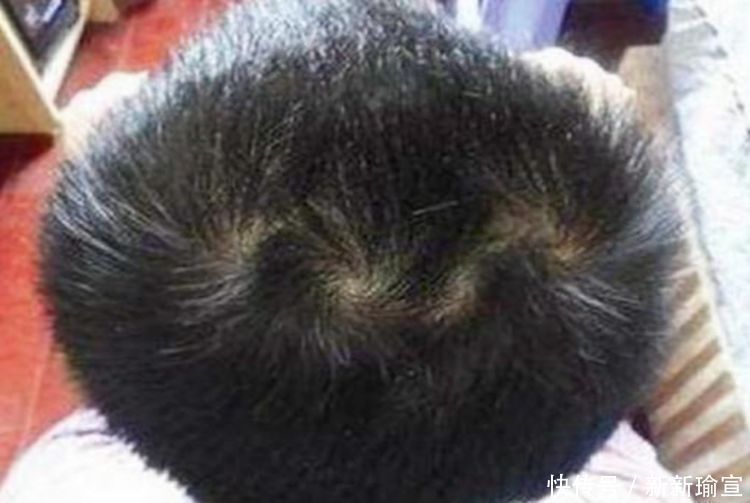 晓雯|孩子头顶上的“两个旋”代表啥?很多父母误解了,看完你就懂了