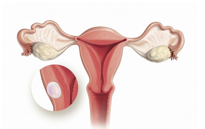 张女士|神奇的桂枝茯苓丸,治好了困扰多年的子宫肌瘤