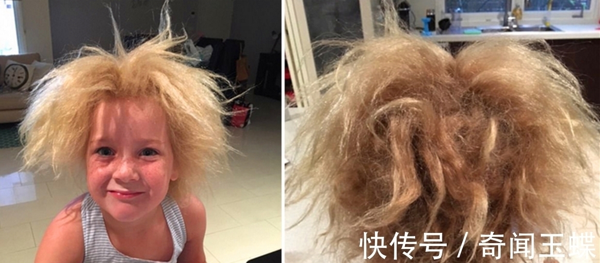 梳头|世界上最奇怪的病,患者不能梳头,全球仅有百例,爱因斯坦是其一