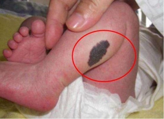 事孕妈|怀孕后三件事孕妈最好别做,容易在宝宝身上留下“胎记”!