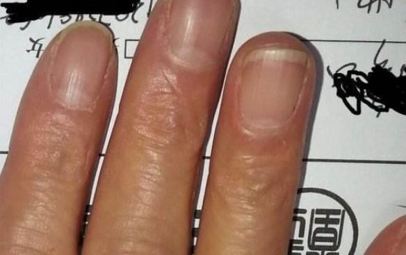 “月牙”越多，身体越好？大部分人都理解错了，看看自己属于哪种