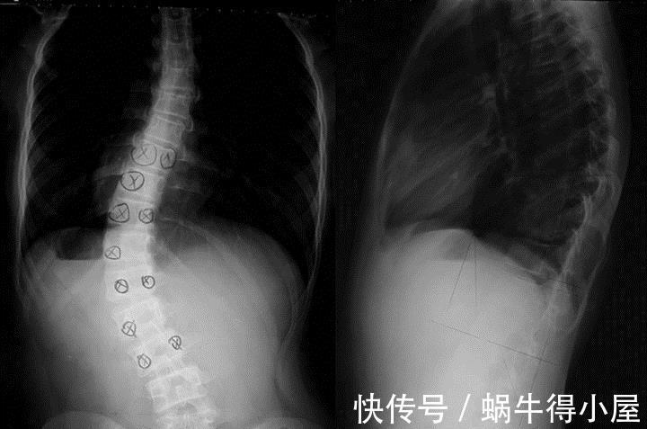 脊柱侧弯|孩子有“恋物癖”，每天摸着毛毯才能睡着？四大坏习惯要及时改正