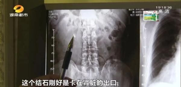 食品|湖南一家三口均患结石，竟是因为爱吃这种食品！