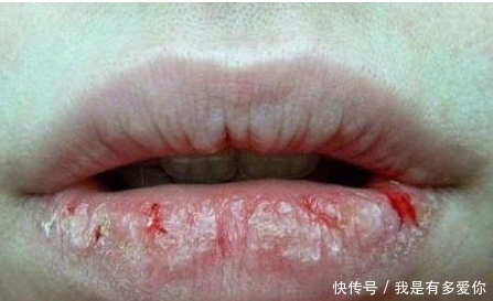 要是不爱护嘴唇,干裂的话!就算把一条河里的水喝光也没用!
