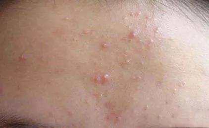 毛孔|闭口痘痘能做哪些皮肤管理？