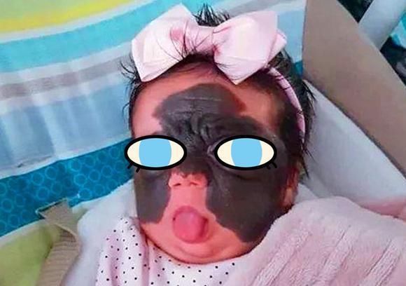 合照|宝妈生下“蝙蝠侠”胎记宝宝,发合照鼓励女儿,不料留言令她崩溃