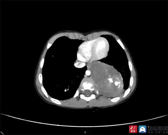 先天性|四岁男孩患肿瘤 泰安市中心医院儿外科新设备助力精准切除