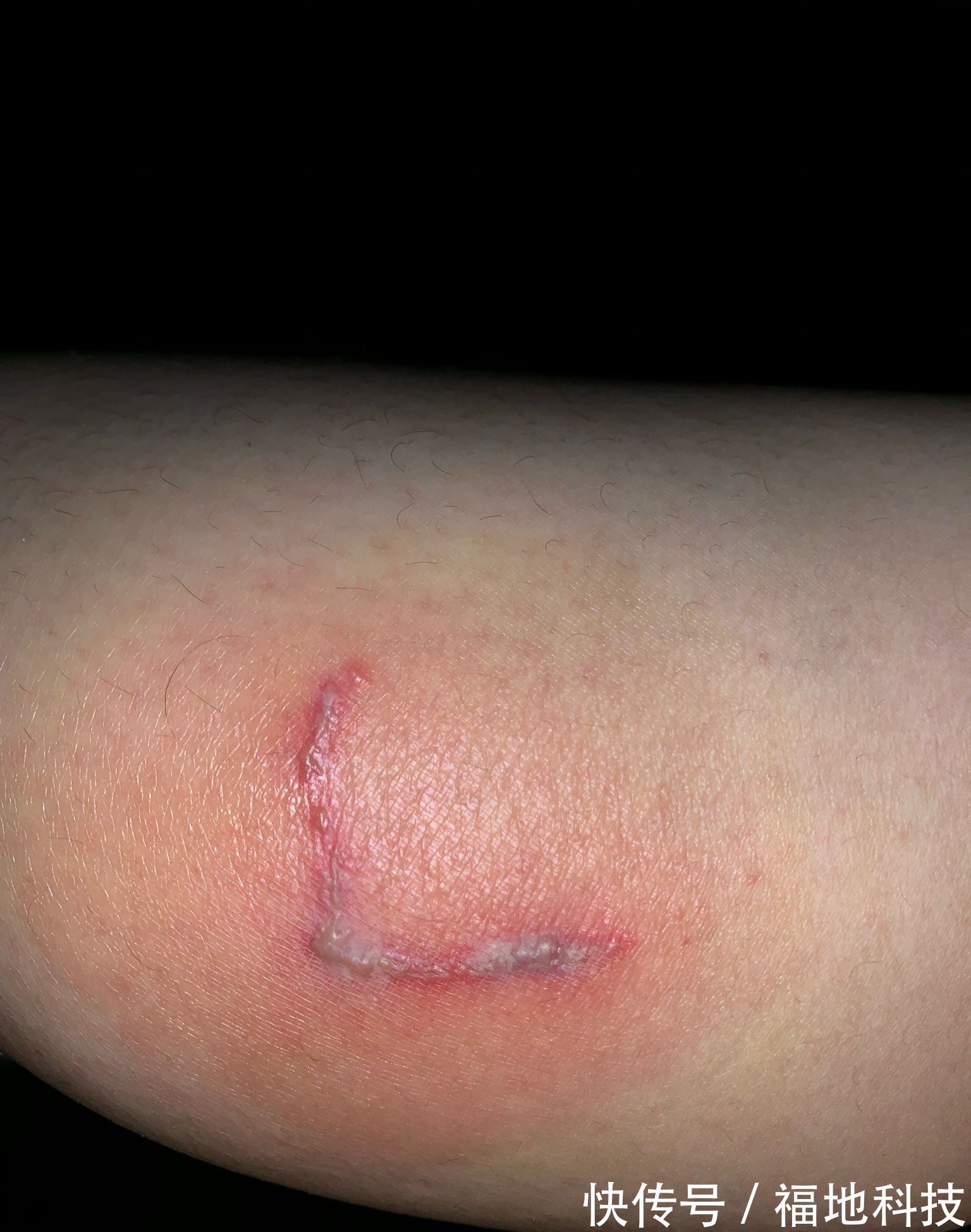 男孩|6岁男孩只因惹了这个小家伙脸部皮肤溃烂。麻烦就在“举手之间”