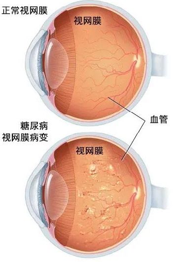 血糖高为什么会伤眼？|【健哥说心脏】全国爱眼日| 视网膜病变