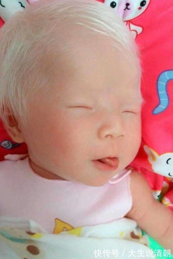 张静|孕妇产下孩子一头白发,医生却说没什么!