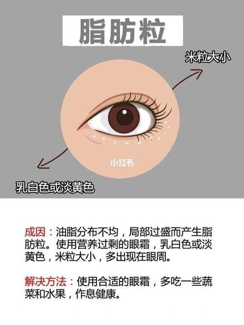 眼部|黑眼圈 、眼袋、 眼角纹、 脂肪粒,它们的形成原因你知道吗?
