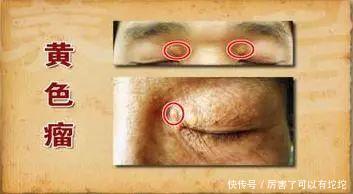 血脂升|心内科医生:血脂高不高看脸就知道,血脂高的人,脸上有3个特征