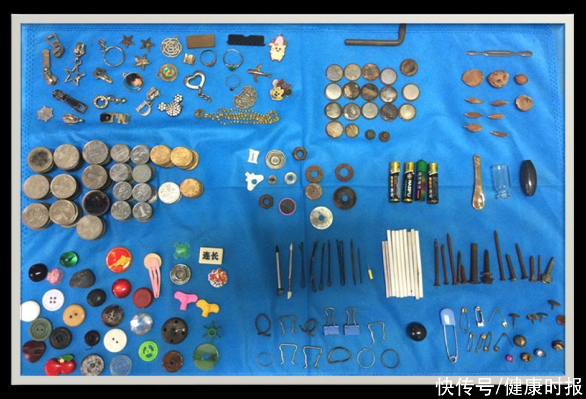 消化道|电池、图钉、戒指……这家医院从小朋友消化道取出的3000件异物可以建展览馆了