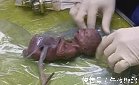 女子|女子生下3指大的婴儿，让在场所有医护人员都震惊了