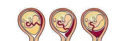 阴道出血|如果孕期发现这5种异常出血情况,立刻去医院!