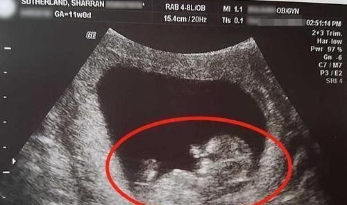 后遗症|女子怀孕14周流产，“胎儿”照片曝光!指甲盖都能看得清清楚楚