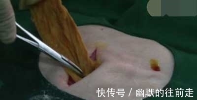 女子|剖腹产生下儿子后,腹部剧痛难忍,医生再次打开肚子,吓得傻了眼