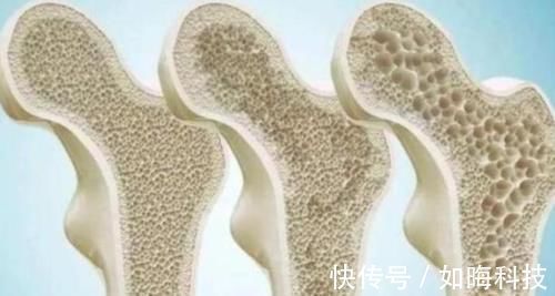 裙带菜|若想远离骨质疏松,这三种菜,尽量远离,日常中可多做这几件事