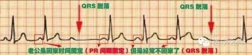 护士这样学心电图，不用死记硬背