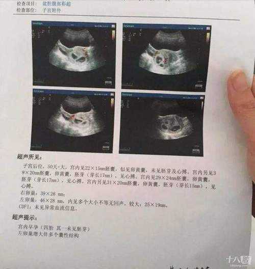 笔账|男子带老婆做孕检,竟是四胞胎!网友算了笔账,一般人真不知道