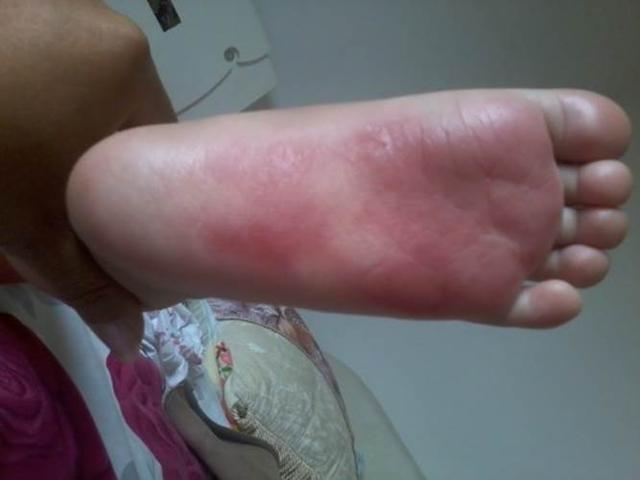 果冻鞋|前有“洞洞鞋”,后有“果冻鞋”,血的教训告诉你为啥别给孩子穿