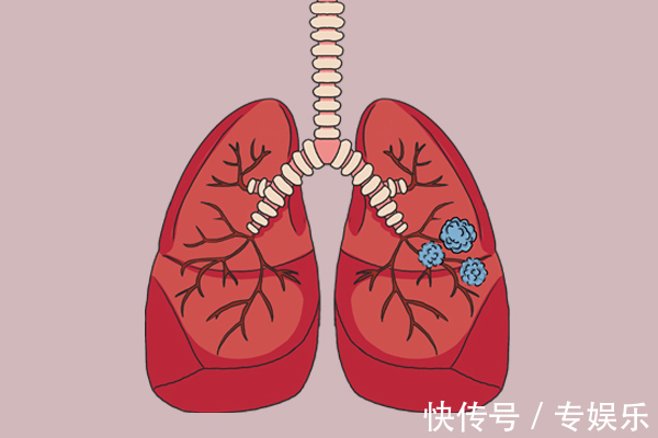 癌变|担心结节迟早要癌变，为什么不尽早切提醒患者，过度医疗不可取