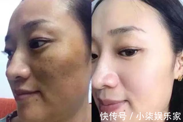 大蒜|老年斑太难看怎么办老奶奶教你3招，淡化20年斑，试过都说好