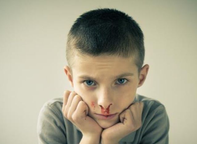 孩子|5岁男孩鼻子流血，爸爸“三个果断”救了孩子，医生：值得借鉴
