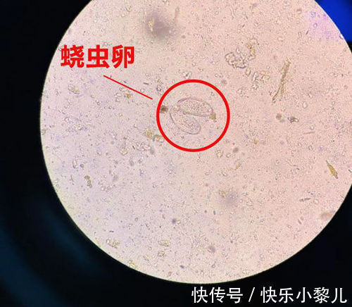 感染率|2岁女儿患上“蛲虫病”,得知原因后,宝妈直接气得带孩子回娘家
