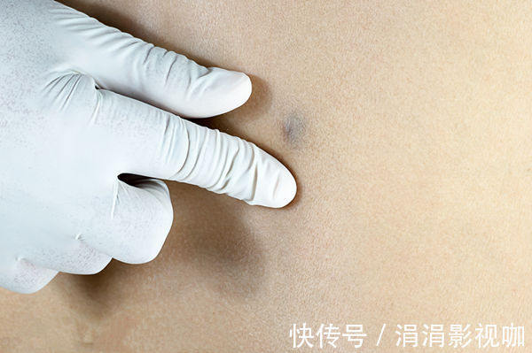 切除|年过50想长寿,要留心身上的4个“小凸起”,离癌症近的人才会有
