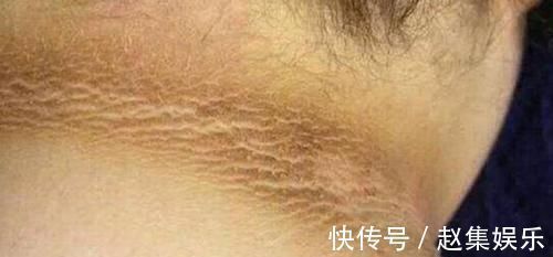 高热量|9岁小女孩脖颈发黑洗不掉,去医院检查后,医生的解释让家长笑了