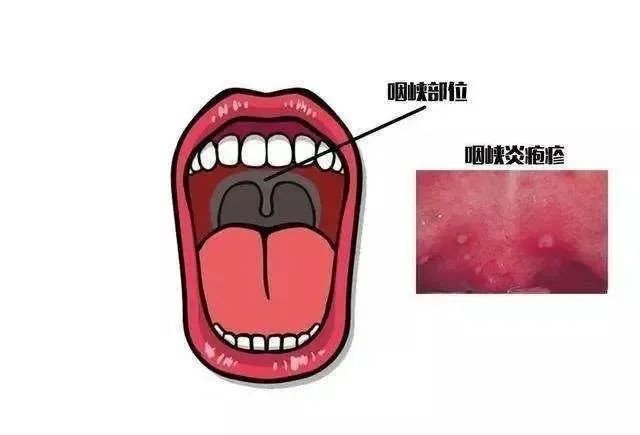 肠道病毒|警惕！这种病进入高发，会传染！