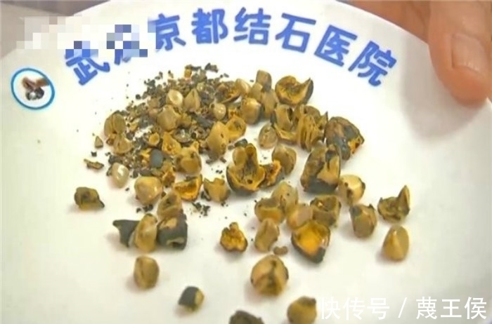 结石|少吃肉多吃菜,素食女体内长出40多颗结石,原因让人深思
