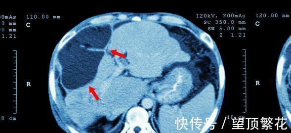 胆汁酸盐|皮肤经常瘙痒,别以为只是皮肤过敏,还要注意肝功能检查,多留意