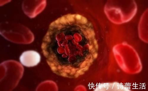 中脘穴|穴位妙用,常按5个穴位,解决高血脂,远离心脑血管疾病