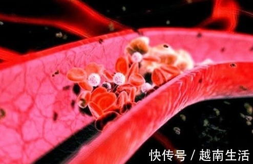 疏通血管|血管堵、血管硬,1个动作,每天拍一拍,疏通血管,冲走血管垃圾