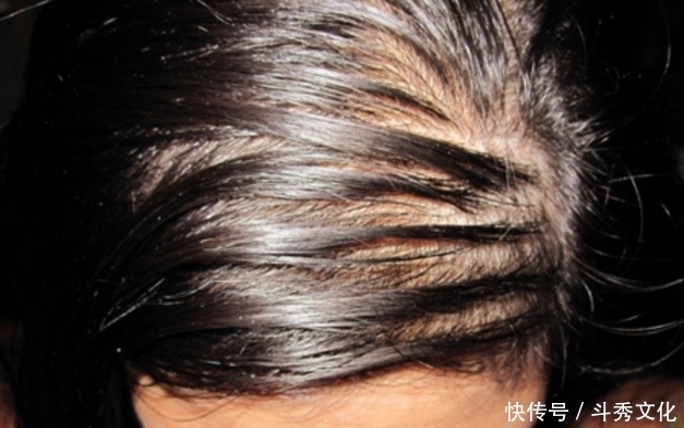 用来|“阿司匹林”能用来洗头发?或许能尝到3个“甜头”,不妨一试