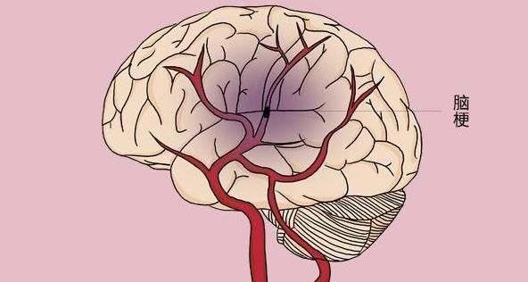  血压高|血压高患者，头部频繁有“异象”，要多提防脑梗