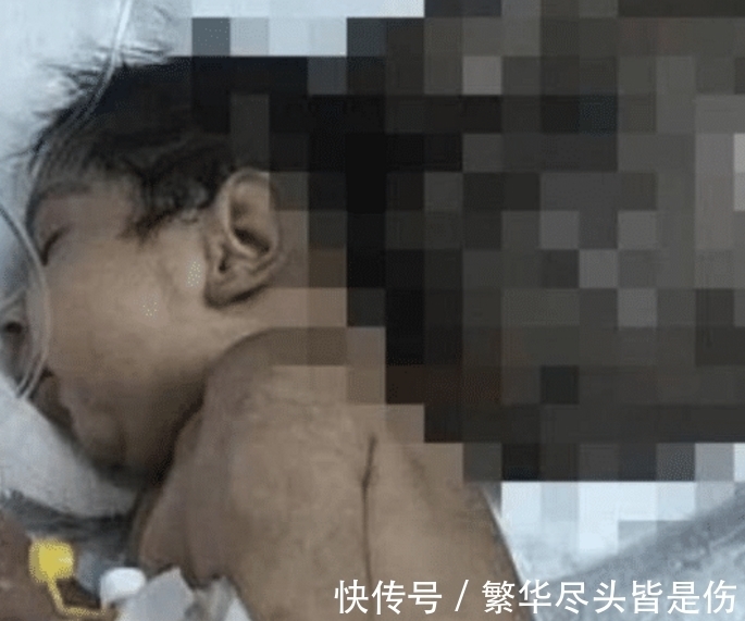 医生|残疾小孩被父亲残忍掩埋,医生全力救助,心疼!