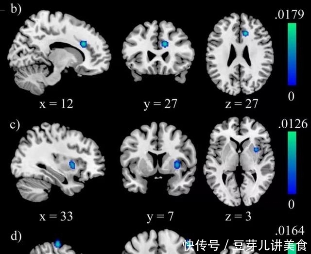 研究|NBR经典文献解读：焦虑个体的静息态脑网络功能连接性研究