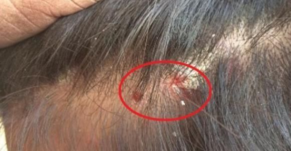  内分泌|头皮上总有“痘痘”，抠破流血伴随疼痛？暴露3大问题一定要重视