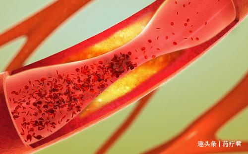 高脂血症|不吃荤、只吃素,血脂为何不降反升医生你吃素吃错了!