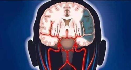 一旦头上出现三种异常，说明体内有血栓了，常吃5物，脑梗不扰