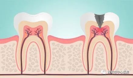 疼痛|补好的牙为什么还会痛？